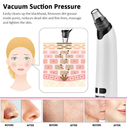 6-in-1 Rechargeable Blackhead Removal Machine  Vacuum Suction & Derma Care Tool