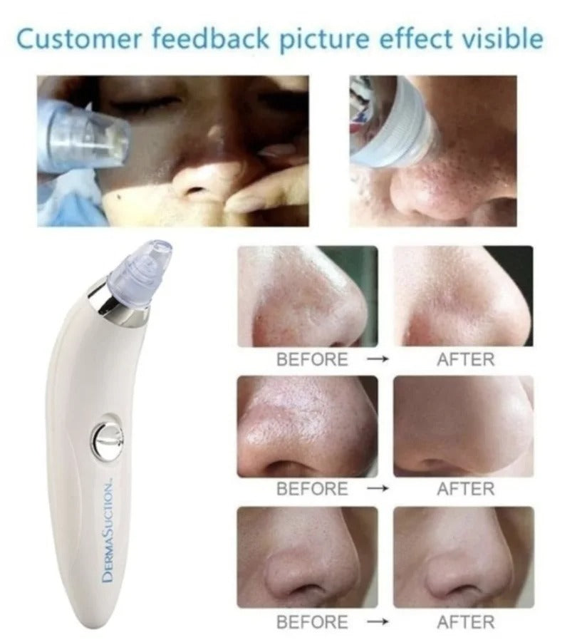 Derma Suction Blackhead Remover | Powerful Vacuum Pore Cleaner Battery Operated